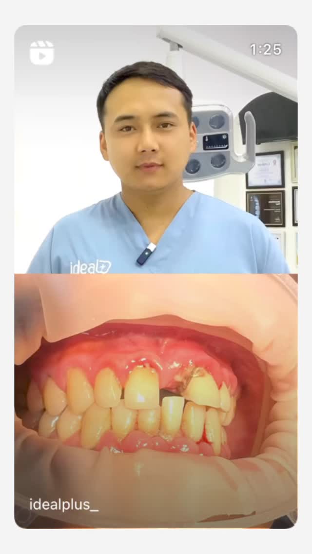 Профессиональная чистка зубов