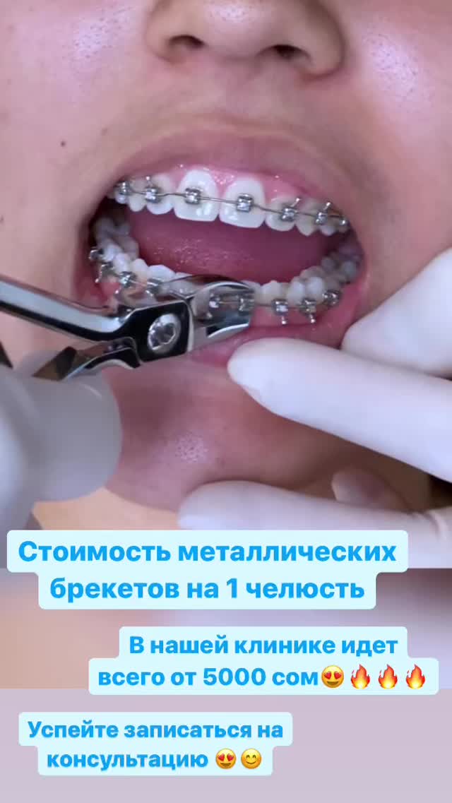 Установка брекет-систем