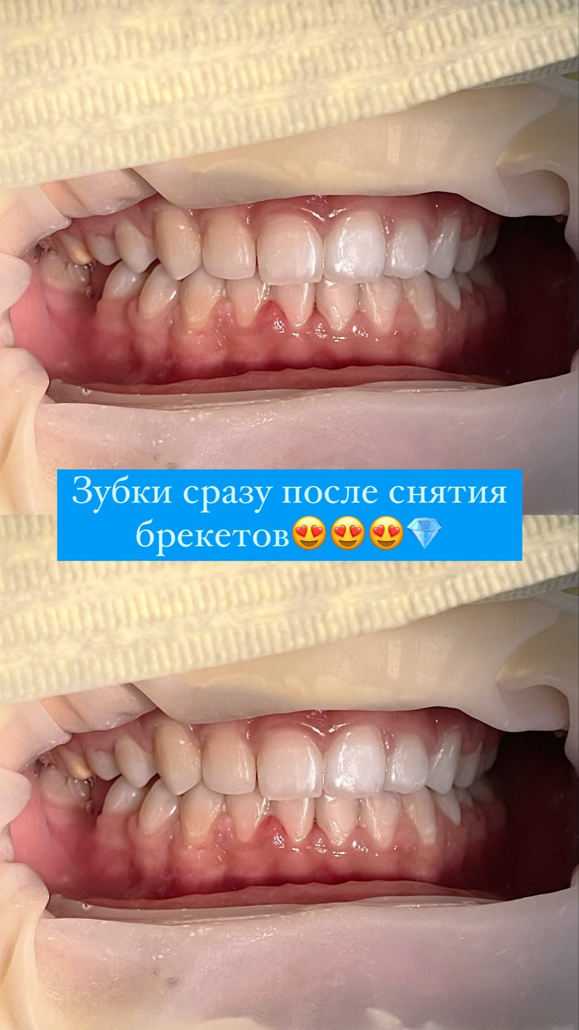 Брекеты Идеал Плюс