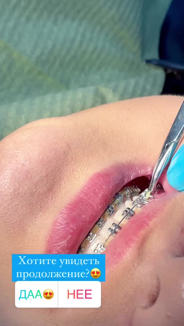 Брекеты Идеал Плюс