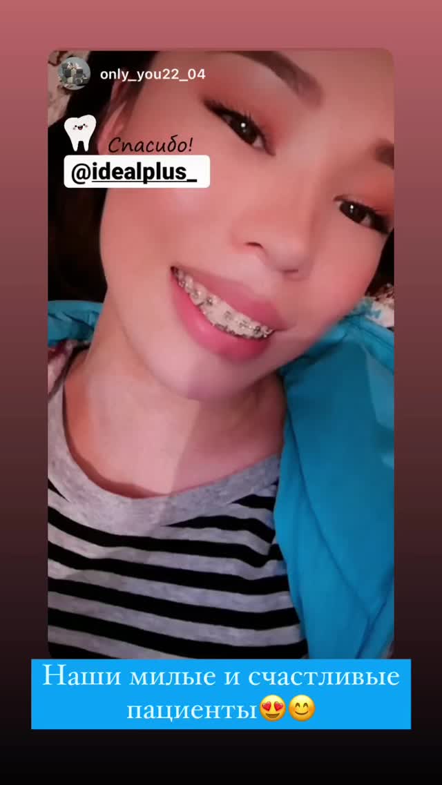 Брекеты Идеал Плюс