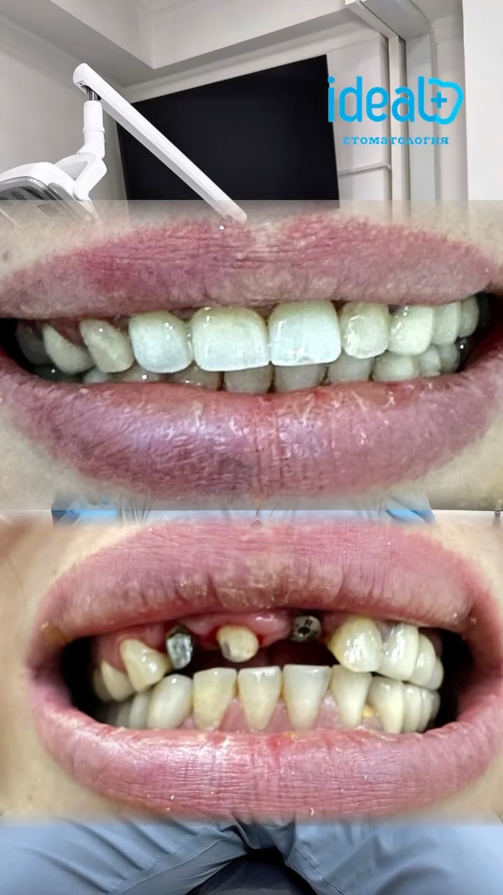 Имплантация зубов