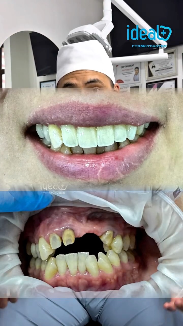 Протезирование